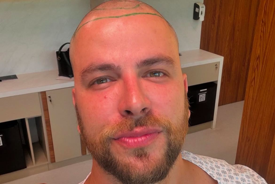 Médico faz alerta sobre procedimento do ex-BBB Gustavo Marsengo 1 Médico faz alerta sobre procedimento do ex-BBB Gustavo Marsengo